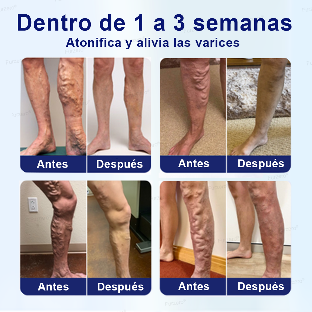 🏆🏆Hecho y enviado desde México🌿Furzero® VeinFreedom Spray Herbario - Terapia de MicroNiebla