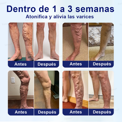 🏆Hecho y enviado desde México🌿Furzero® VeinFreedom Spray Herbario - Terapia de MicroNiebla