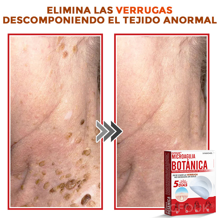 🌈 GFOUK® Parche Botánico de Microagujas para Eliminar Verrugas y Acrocordones 🇲🇽 Producto 100% 👑