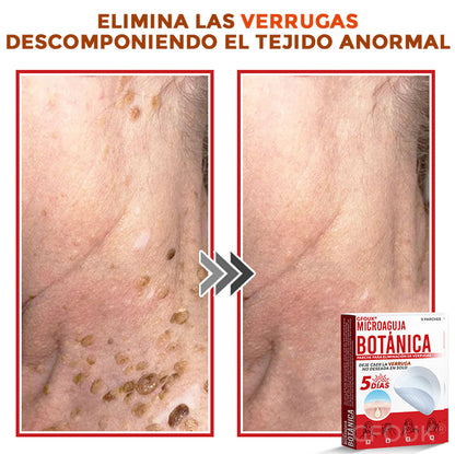🌈 GFOUK® Parche Botánico de Microagujas para Eliminar Verrugas y Acrocordones 🇲🇽 Producto 100% 👑