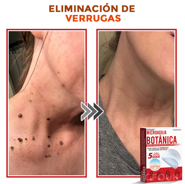 🌈 GFOUK® Parche Botánico de Microagujas para Eliminar Verrugas y Acrocordones 🇲🇽 Producto 100% 👑
