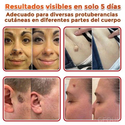 🌈 GFOUK® Parche Botánico de Microagujas para Eliminar Verrugas y Acrocordones 🇲🇽 Producto 100% 👑